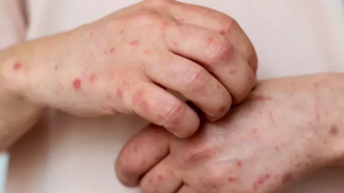 Alta vacunación mantiene a El Salvador sin sarampión mientras aumentan casos en la región